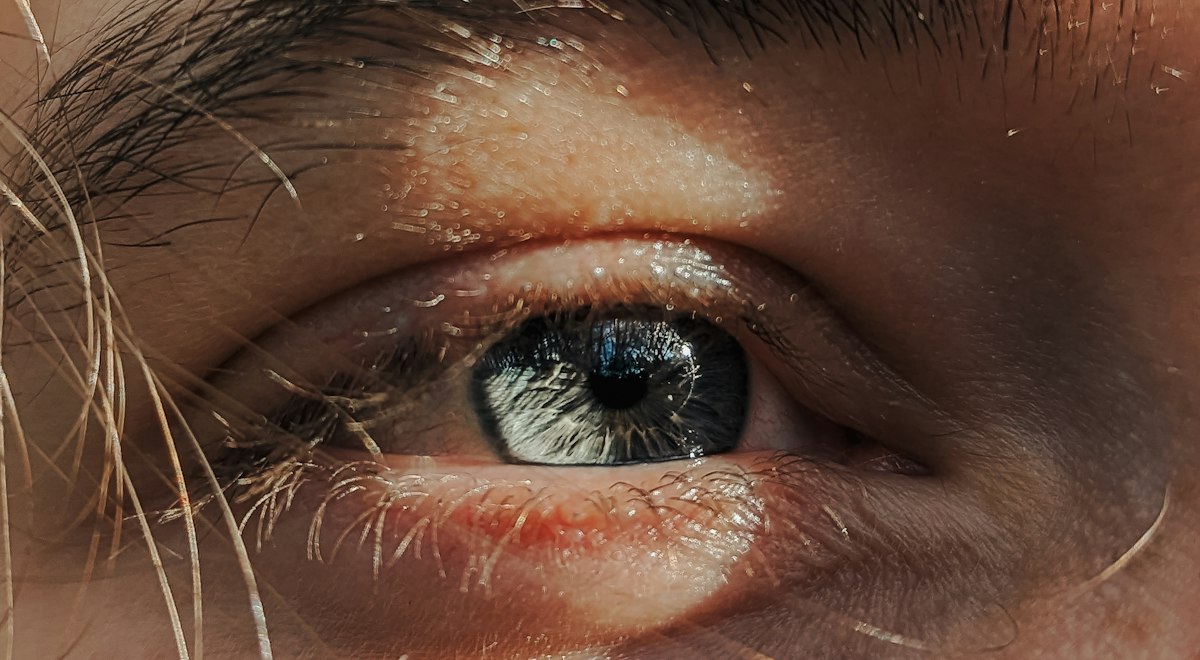 Close-up of a red, irritated eye, a common sign of conjunctivitis during the monsoon