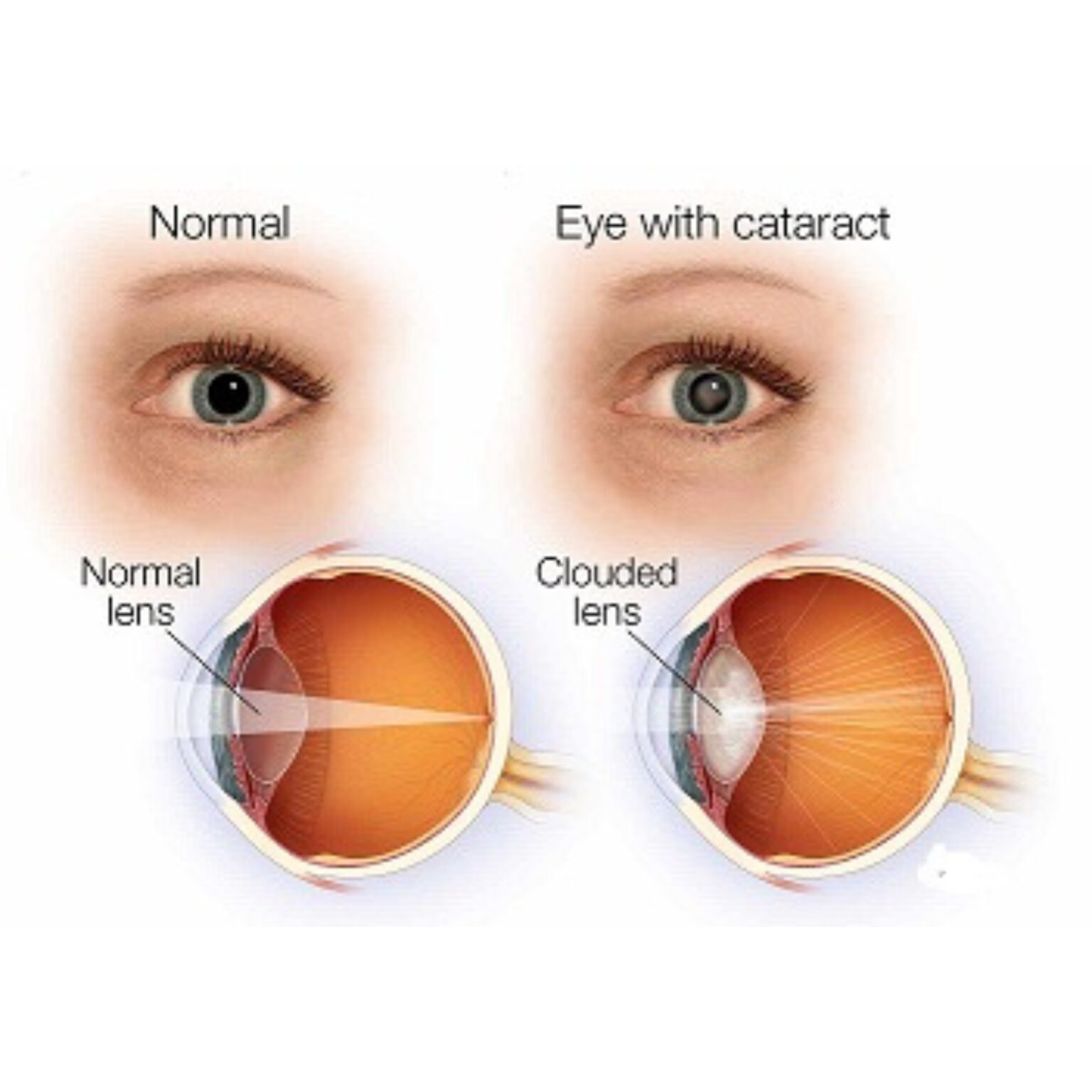 Eye with Cataract - Cloudy Lens Example