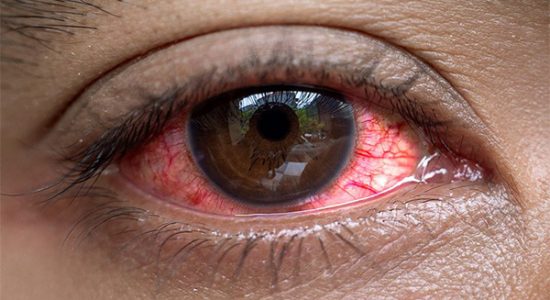 Dry Eye Treatment