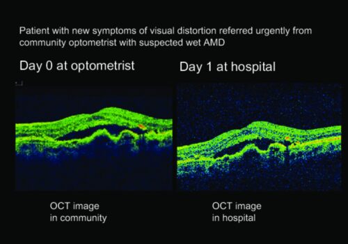 Diabetic Retinopathy and Macular Degeneration Eye Scans