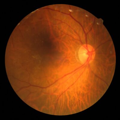 Retinal Tears and Laser Treatment Illustration