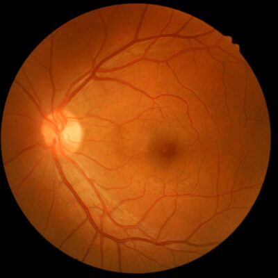Retinal Macular Edema Treatment Concept