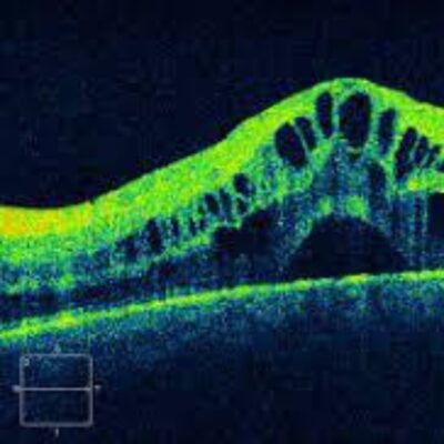 Retina Surgery and Recovery Support at Trivision Eye Hospital