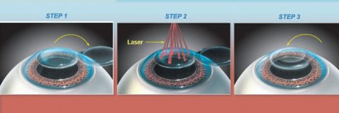 How LASIK Eye Surgery Works