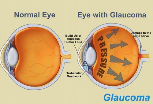 Glaucoma Symptoms and Optic Nerve Damage