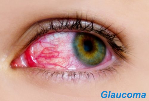Intraocular Pressure and Fluid Flow in Eye