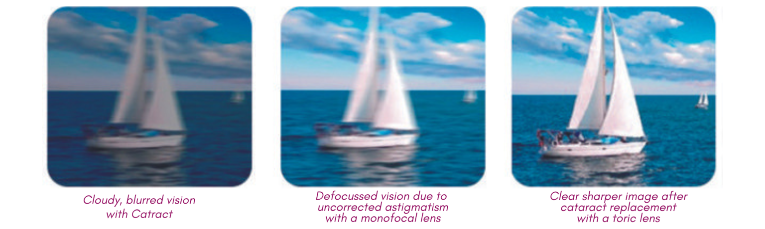 Multifocal and Trifocal IOL Image