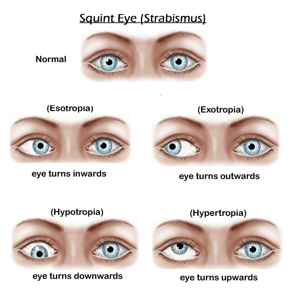 Squint Eye Alignment Illustration